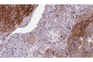 ABIN6276819 at 1/100 staining Human urothelial cancer tissue by IHC-P. (S100A8 antibody  (C-Term))