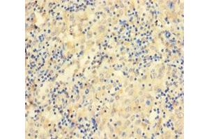 Immunohistochemistry of paraffin-embedded human lung cancer using ABIN7156529 at dilution of 1:100 (CCDC36 antibody  (AA 11-592))