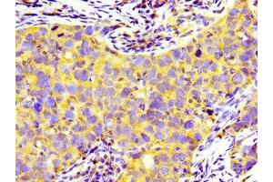 Immunohistochemistry of paraffin-embedded human pancreatic cancer using ABIN7158932 at dilution of 1:100 (PRNP antibody  (AA 23-64))