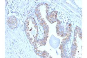 Formalin-fixed, paraffin-embedded human Prostate Carcinoma stained with PMEPA1 Mouse Monoclonal Antibody (PMEPA1/2697). (PMEPA1 antibody)