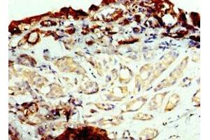 Immunohistochemistry of paraffin-embedded human breast cancer using ABIN7143737 at dilution of 1:100 (FUT6 antibody  (AA 170-359))