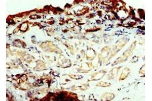 Immunohistochemistry of paraffin-embedded human breast cancer using ABIN7143737 at dilution of 1:100