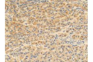 IHC-P analysis of Human Liver Cancer Tissue, with DAB staining. (MGP antibody  (AA 1-103))