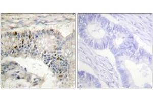 Immunohistochemistry analysis of paraffin-embedded human colon carcinoma tissue, using Histone H1 (Ab-17) Antibody.