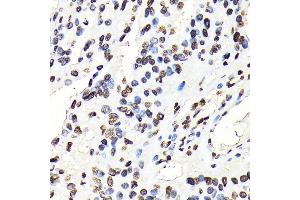 Immunohistochemistry of paraffin-embedded human oophoroma using Phospho-STA-Y694 antibody (ABIN6135328, ABIN6136272, ABIN6136273 and ABIN7101887) at dilution of 1:100 (40x lens). (STAT5A antibody  (pTyr694))