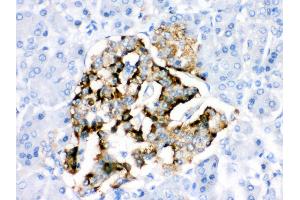 Anti- BAG2 Picoband antibody,IHC(P) IHC(P): Human Pancreatic Cancer Tissue (BAG2 antibody  (AA 1-211))