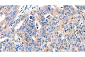 Immunohistochemistry of paraffin-embedded Human ovarian cancer tissue using KLK2 Polyclonal Antibody at dilution 1:100 (Kallikrein 2 antibody)