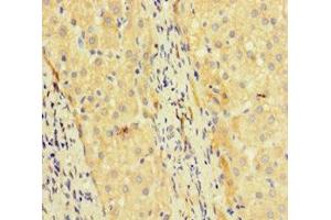 Immunohistochemistry of paraffin-embedded human liver cancer using ABIN7172463 at dilution of 1:100 (TCF4 antibody  (AA 419-525))