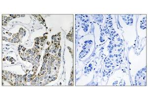 Immunohistochemistry analysis of paraffin-embedded human breast carcinoma tissue using BLK (Phospho-Tyr501) antibody.