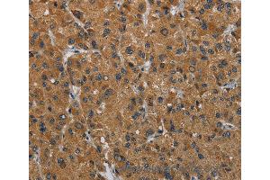 Immunohistochemistry of Human liver cancer using HSD3B7 Polyclonal Antibody at dilution of 1:40