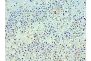 Immunohistochemistry of paraffin-embedded human breast cancer using ABIN7173326 at dilution of 1:100 (TFF1 antibody  (AA 25-84))