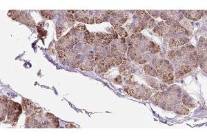 ABIN6273285 at 1/100 staining Human pancreas cancer tissue by IHC-P. (PACS2 antibody  (Internal Region))