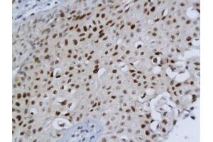 Formalin-fixed and paraffin embedded human bladder cancer labeled with Anti-DBC1/DELETED IN BLADDER CANCER 1 Polyclonal Antibody, Unconjugated  followed by conjugation to the secondary antibody and DAB staining (DBC1 antibody  (AA 101-200))