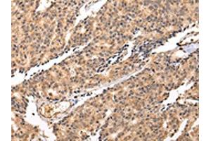 The image on the left is immunohistochemistry of paraffin-embedded Human prostate cancer tissue using ABIN7131260(SWAP70 Antibody) at dilution 1/20, on the right is treated with fusion protein. (SWAP7 antibody)