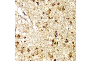 Immunohistochemistry of paraffin-embedded human brain cancer using SMAD9 antibody at dilution of 1:100 (x400 lens).
