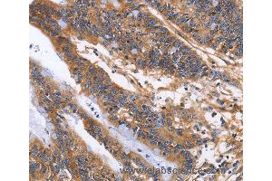 Immunohistochemistry of Human colon cancer using ITGB1 Polyclonal Antibody at dilution of 1:60 (ITGB1 antibody)