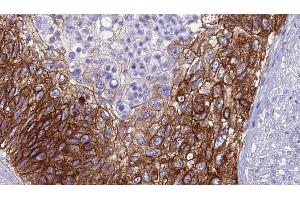 ABIN6268897 at 1/100 staining Human urothelial cancer tissue by IHC-P. (Claudin 4 antibody  (C-Term))