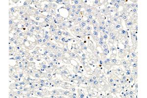 ABIN6263158 and ABIN6266586 at 1/100 staining Human liver cancer and adjacent normal tissues by IHC-P. (MCM2 antibody  (N-Term))