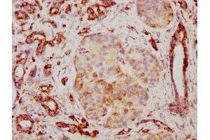 IHC image of ABIN7127858 diluted at 1:117 and staining in paraffin-embedded human pancreatic cancer performed on a Leica BondTM system. (Recombinant TSPO antibody)