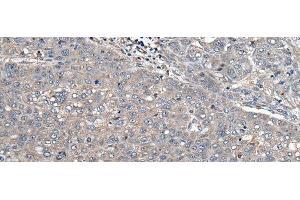 Immunohistochemistry of paraffin-embedded Human liver cancer tissue using ARL1 Polyclonal Antibody at dilution of 1:50(x200) (ARL1 antibody)