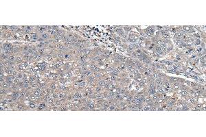 Immunohistochemistry of paraffin-embedded Human liver cancer tissue using ARL1 Polyclonal Antibody at dilution of 1:50(x200)