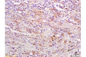 Formalin-fixed and paraffin embedded human lung carcinoma labeled Anti-DAPK2/DRP1 Polyclonal Antibody, Unconjugated (ABIN733358) at 1:200, followed by conjugation to the secondary antibody and DAB staining (Dapk1/2 (AA 271-370) antibody)