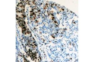 Immunohistochemical analysis of TFIIF RAP 30 staining in human colon cancer formalin fixed paraffin embedded tissue section.
