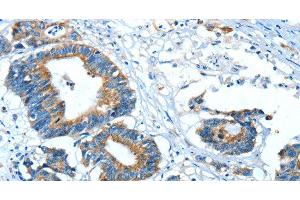 Immunohistochemistry of paraffin-embedded Human colon cancer using GLRA1 Polyclonal Antibody at dilution of 1:30 (GLRA1 antibody)