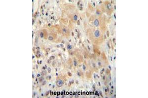 NR0B2 antibody (Center) immunohistochemistry analysis in formalin fixed and paraffin embedded human hepatocarcinoma followed by peroxidase conjugation of the secondary antibody and DAB staining. (NR0B2 antibody  (Middle Region))
