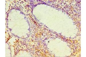 Immunohistochemistry of paraffin-embedded human colon cancer using ABIN7164384 at dilution of 1:100 (DHX58 antibody  (AA 389-678))