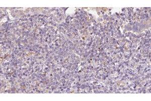 ABIN6273171 at 1/100 staining Human lymph cancer tissue by IHC-P.