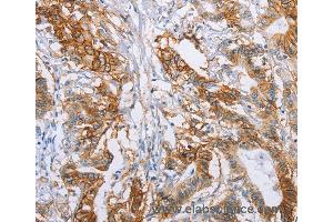 Immunohistochemistry of Human liver cancer using CA9 Polyclonal Antibody at dilution of 1:50 (CA9 antibody)