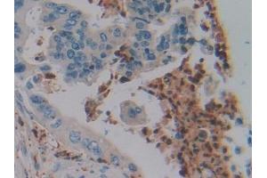 Detection of DEFa4 in Human Colorectal cancer Tissue using Polyclonal Antibody to Defensin Alpha 4, Corticostatin (DEFa4) (DEFA4 antibody  (AA 23-97))