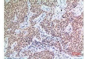 Immunohistochemistry (IHC) analysis of paraffin-embedded Human Mammary Cancer, antibody was diluted at 1:100. (P57 (Ser24) antibody)