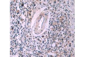 Used in DAB staining on fromalin fixed paraffin- embedded stomach cancer tissue (SFRP4 antibody  (AA 25-222))