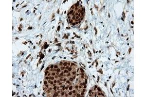 Immunohistochemical staining of paraffin-embedded Adenocarcinoma of colon tissue using anti-LTA4H mouse monoclonal antibody. (LTA4H antibody)