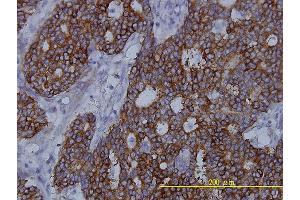 Immunoperoxidase of monoclonal antibody to FASN on formalin-fixed paraffin-embedded human breast cancer tissue. (Fatty Acid Synthase antibody  (AA 1-439))