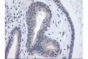 Immunohistochemical staining of paraffin-embedded Adenocarcinoma of Human endometrium tissue using anti-XPNPEP3 mouse monoclonal antibody. (XPNPEP3 antibody)