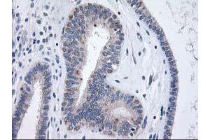 Immunohistochemical staining of paraffin-embedded Adenocarcinoma of Human endometrium tissue using anti-XPNPEP3 mouse monoclonal antibody.