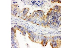 IHC-P: HIF-1-alpha antibody testing of human intestinal cancer tissue (HIF1A antibody  (AA 703-732))