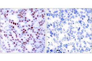 Immunohistochemical analysis of paraffin-embedded human breast carcinoma tissue, using c-Jun (epitope around residue 243) antibody (ABIN5976223). (C-JUN antibody  (Ser243))