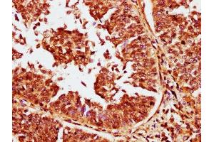 IHC image of ABIN7146274 diluted at 1:400 and staining in paraffin-embedded human cervical cancer performed on a Leica BondTM system. (CABIN1 antibody  (AA 1978-2123))