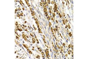Immunohistochemistry of paraffin-embedded human stomach cancer using TACR3 antibody.