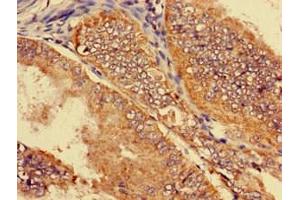 Immunohistochemistry of paraffin-embedded human endometrial cancer using ABIN7170144 at dilution of 1:100 (SLC22A2 antibody  (AA 48-135))