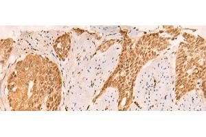 Immunohistochemistry of paraffin-embedded Human esophagus cancer tissue using SETD1A Polyclonal Antibody at dilution of 1:25(x200) (SETD1A antibody)