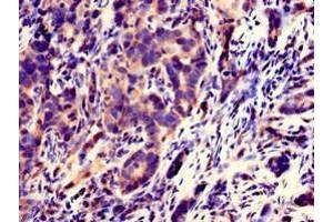Immunohistochemistry of paraffin-embedded human pancreatic cancer using ABIN7170444 at dilution of 1:100