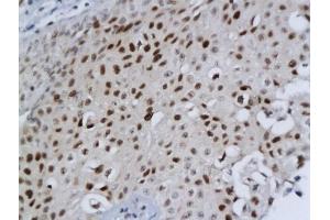 Formalin-fixed and paraffin embedded human bladder cancer labeled with Anti-DBC1/DELETED IN BLADDER CANCER 1 Polyclonal Antibody, Unconjugated (ABIN680308) followed by conjugation to the secondary antibody and DAB staining (DBC1 antibody  (AA 101-200))