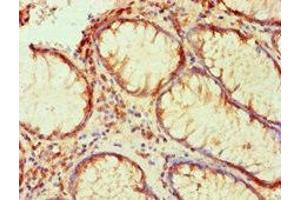 Immunohistochemical of paraffin-embedded human colon cancer using ABIN7176818 at dilution of 1:200. (PLA2G7 antibody)