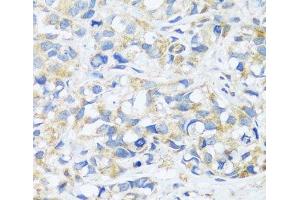 Immunohistochemistry of paraffin-embedded Human breast cancer using BRK1 Polyclonal Antibody at dilution of 1:100 (40x lens). (BRK1 antibody)