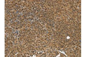 The image on the left is immunohistochemistry of paraffin-embedded Human ovarian cancer tissue using ABIN7192784(TGM7 Antibody) at dilution 1/30, on the right is treated with synthetic peptide. (Transglutaminase 7 antibody)